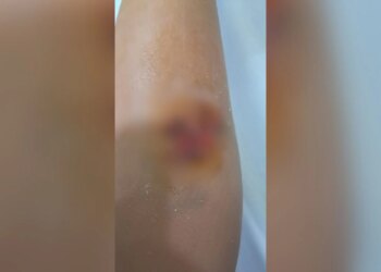 Ngjarje e rëndë, një fëmijë 8-vjeçar sulmohet nga një qen endacak në Durrës