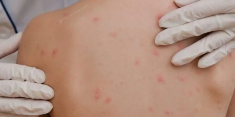 Alarm në SHBA: Raste të reja të fruthit në disa shtete/ Mjekët: Vaksinimi po bie ndjeshëm