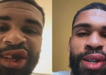 Loftus-Cheek shpërndan imazhe pa dhëmbë dhe falenderon të gjithë për mbështetje: Të keqen e lamë pas.