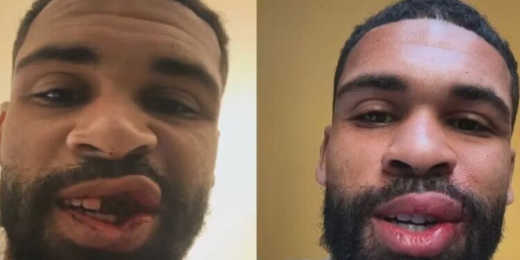 Loftus-Cheek shpërndan imazhe pa dhëmbë dhe falenderon të gjithë për mbështetje: Të keqen e lamë pas.